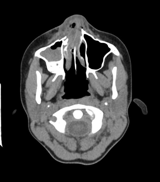 File:Nasoorbitoethmoid fracture (Radiopaedia 90044-107205 Axial non-contrast 115).jpg