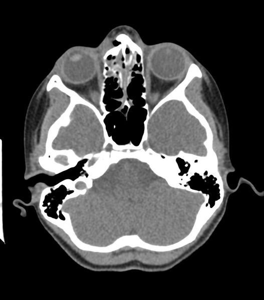 File:Nasoorbitoethmoid fracture (Radiopaedia 90044-107205 Axial non-contrast 155).jpg