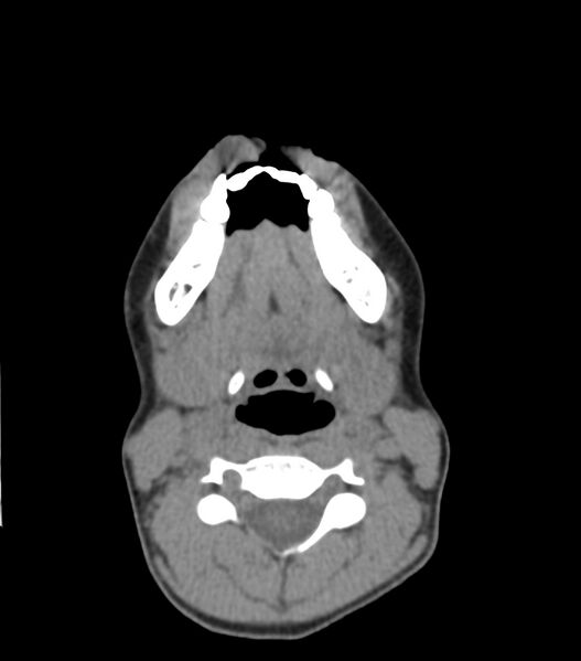 File:Nasoorbitoethmoid fracture (Radiopaedia 90044-107205 Axial non-contrast 54).jpg