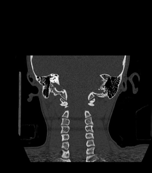 File:Nasoorbitoethmoid fracture (Radiopaedia 90044-107205 Coronal bone window 113).jpg