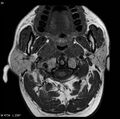 Nasopharyngeal carcinoma (Radiopaedia 4546-6667 Axial T1 12).jpg