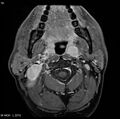 Nasopharyngeal carcinoma (Radiopaedia 4546-6667 Axial T1 C+ fat sat 16).jpg