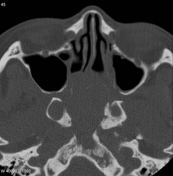 File:Nasopharyngeal carcinoma (recurrent) (Radiopaedia 5061-6903 Axial non-contrast 6).jpg