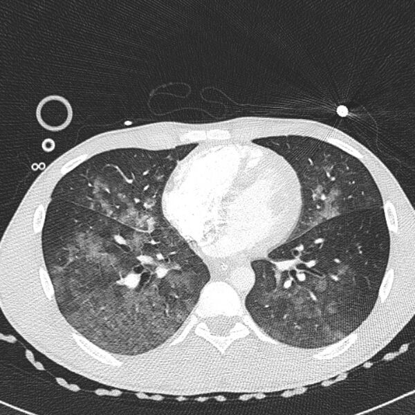 File:Near drowning (pulmonary edema) (Radiopaedia 24685-24958 lung window 44).jpg