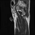 Necrotizing epididymo-orchitis with intra-testicular abscess (Radiopaedia 29397-29860 Sagittal T2 2).jpg