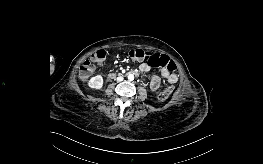 Neo-terminal ileal stricture (Crohn disease) (Radiopaedia 33790-34948 A 224).jpg