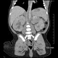 Neonatal neuroblastoma (Radiopaedia 56651-63438 Coronal non-contrast 34).jpg
