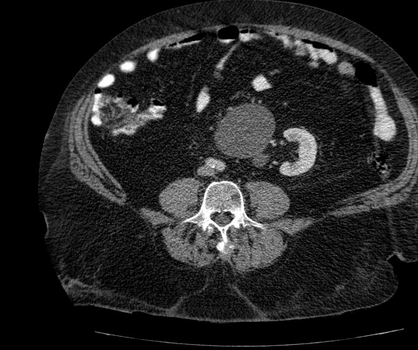 Nephroptosis with inguinal hernia containing perirenal fat (Radiopaedia 56632-63391 C 211).jpg