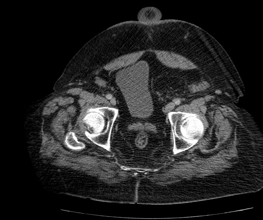 Nephroptosis with inguinal hernia containing perirenal fat (Radiopaedia 56632-63391 C 307).jpg