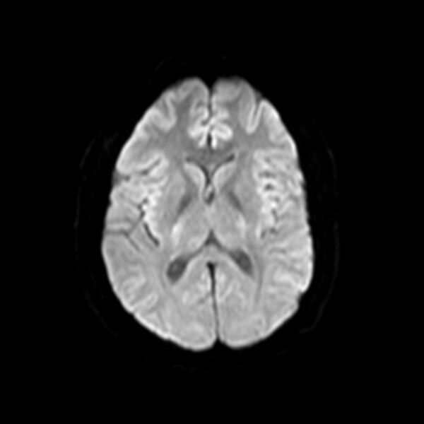 File:Neurofibromatosis type 2 (Radiopaedia 67470-76871 Axial DWI 11).jpg