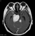 Neurofibromatosis type 2 - cranial and spinal involvement (Radiopaedia 5351-7111 Axial T1 C+ 8).jpg