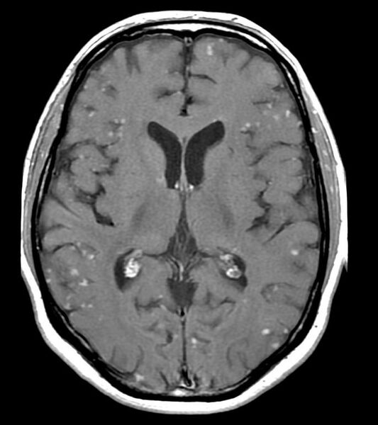 File:Neurosarcoidosis (Radiopaedia 11674-12037 E 1).jpg