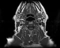 Non-Hodgkin lymphoma - parotid gland (Radiopaedia 71531-81890 Axial T1 6).jpg