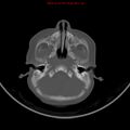 Non-accidental injury - bilateral subdural with acute blood (Radiopaedia 10236-10765 Axial bone window 4).jpg
