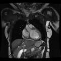 Non-compaction of the left ventricle (Radiopaedia 38868-41062 1CH SSFP CINE 17).jpg