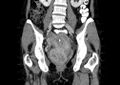 Non-puerperal uterine inversion (Radiopaedia 78343-91094 B 20).jpg