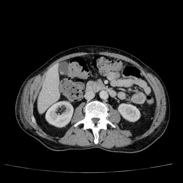 File:Non small-cell lung cancer (Radiopaedia 24467-24769 C+ delayed 77).jpg