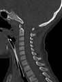Normal CT cervical spine - pediatric (Radiopaedia 52549-58462 Sagittal bone window 91).jpg
