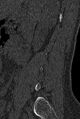 Normal CT lumbar spine (Radiopaedia 53981-60118 Sagittal bone window 5).jpg