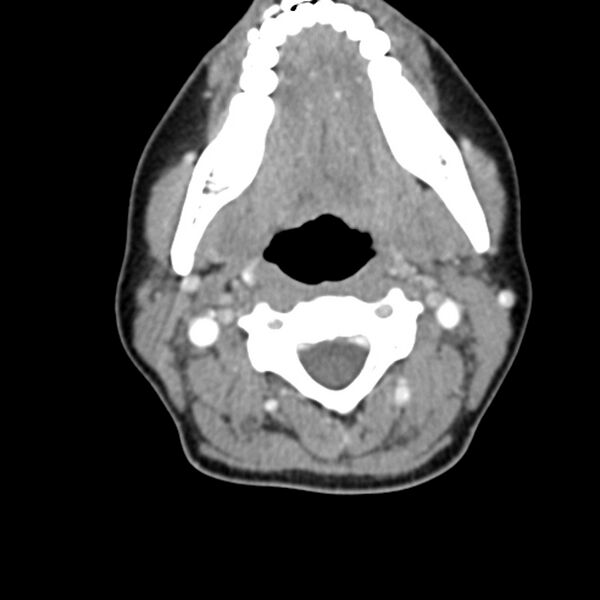 File:Normal CT of the neck (Radiopaedia 14575-14500 Axial C+ 31).jpg
