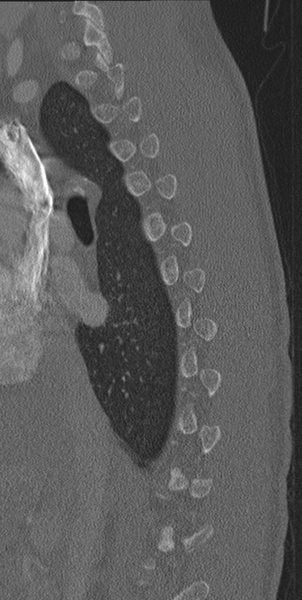 File:Normal CT thoracic spine (Radiopaedia 40181-42688 Sagittal bone window 47).png