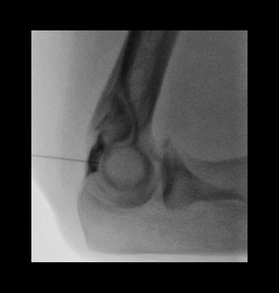 File:Normal elbow arthrograms (Radiopaedia 75550-86830 Lateral 2).jpg