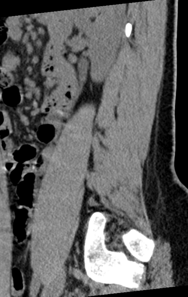 File:Normal lumbar spine CT (Radiopaedia 46533-50986 C 20).png