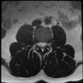 Normal lumbar spine MRI (Radiopaedia 35543-37039 Axial T2 26).png