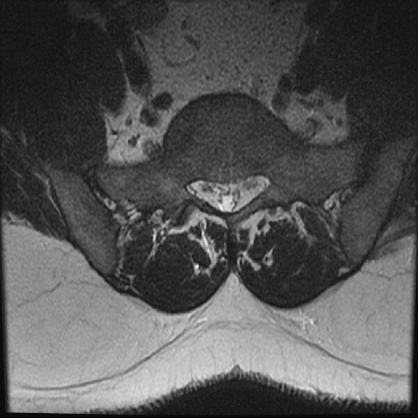 File:Normal lumbar spine MRI (Radiopaedia 43051-46311 Axial T2 26).jpg