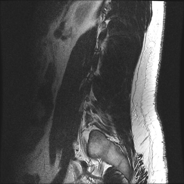File:Normal lumbar spine MRI (Radiopaedia 43051-46311 Sagittal T2 2).jpg