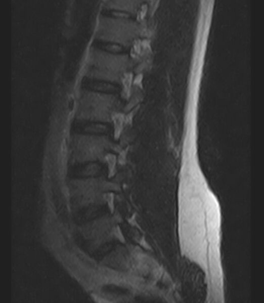 File:Normal lumbar spine MRI - low-field MRI scanner (Radiopaedia 40976-43699 Sagittal T2 9).jpg