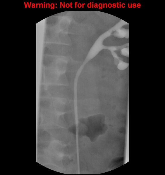 File:Normal retrograde pyelography of a native and transplant kidney (Radiopaedia 40480-43054 Native kidney 10).jpg