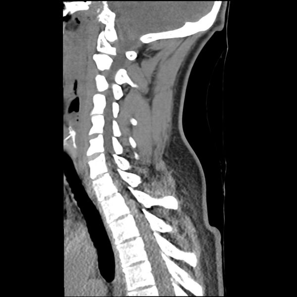 File:Normal trauma spine imaging (Radiopaedia 31753-32686 A 25).jpg