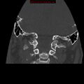 Occipital condyle fracture (Radiopaedia 18366-18208 Coronal bone window 14).jpg