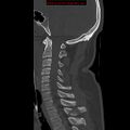 Occipital condyle fracture (Radiopaedia 18366-18208 Sagittal bone window 18).jpg