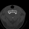 Occipital condyle fracture (Radiopaedia 31755-32691 Axial bone window 20).jpg