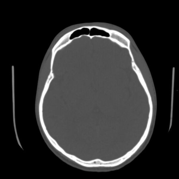File:Occipital spur - asymptomatic (Radiopaedia 87753-104201 Axial bone window 100).jpg
