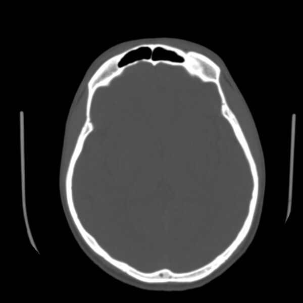 File:Occipital spur - asymptomatic (Radiopaedia 87753-104201 Axial bone window 98).jpg