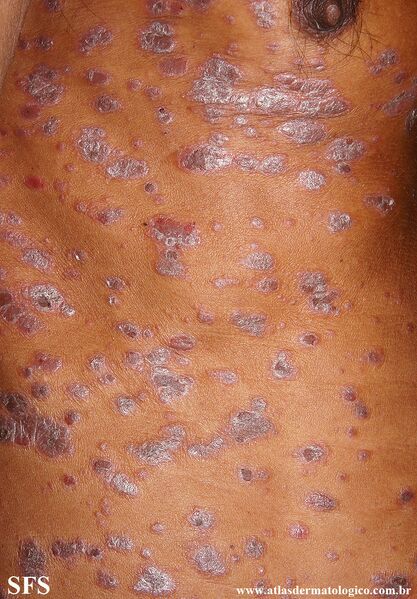 File:Psoriasis (Dermatology Atlas 136).jpg