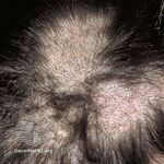 Trichotillomania (DermNet NZ hair-nails-sweat-s-trichotillomania2).jpg