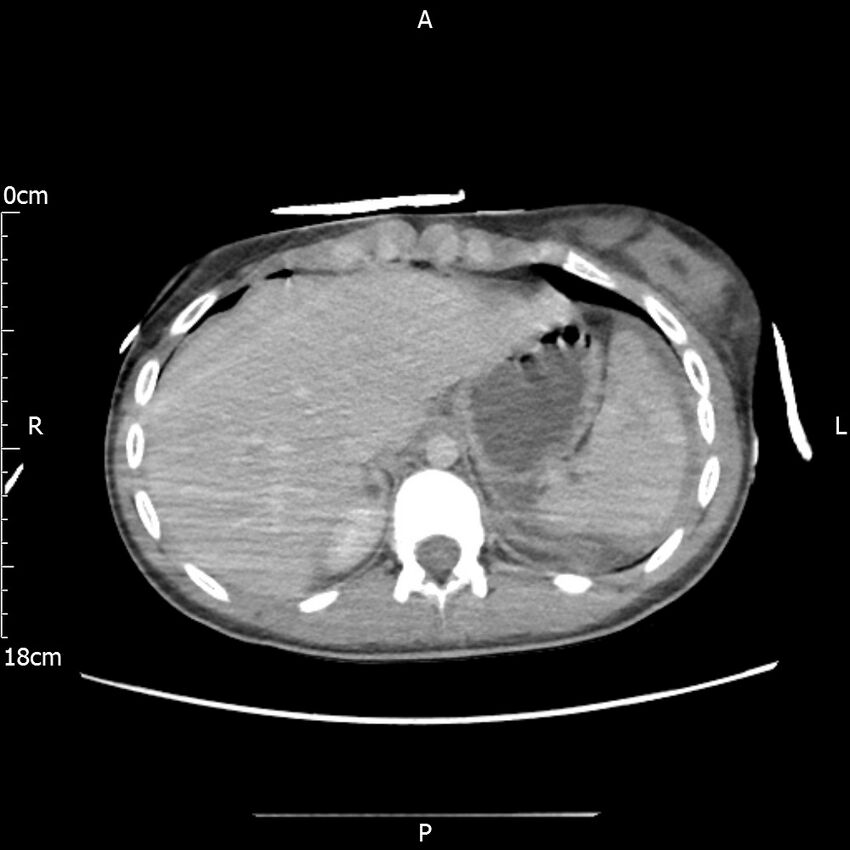 AAST grade IV kidney injury with CEUS follow-up (Radiopaedia 72353-82877 Axial C+ portal venous phase 11).jpg