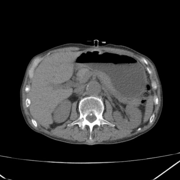 File:Abdominal aortic aneurysm (Radiopaedia 23703-23856 Axial non-contrast 18).jpg