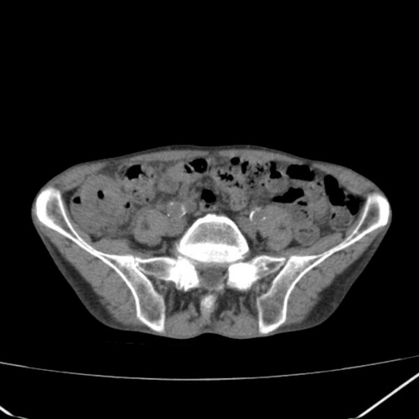 File:Abdominal aortic aneurysm (Radiopaedia 23703-23856 Axial non-contrast 39).jpg