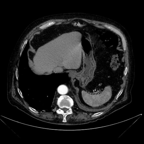 File:Abdominal aortic aneurysm (Radiopaedia 25855-26001 Axial C+ arterial phase 25).jpg
