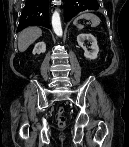 File:Abdominal aortic aneurysm (Radiopaedia 25855-26001 Coronal C+ arterial phase 53).jpg