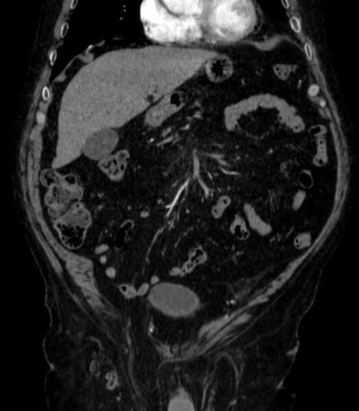 File:Abdominal aortic aneurysm (Radiopaedia 25855-26001 Coronal C+ arterial phase 8).jpg