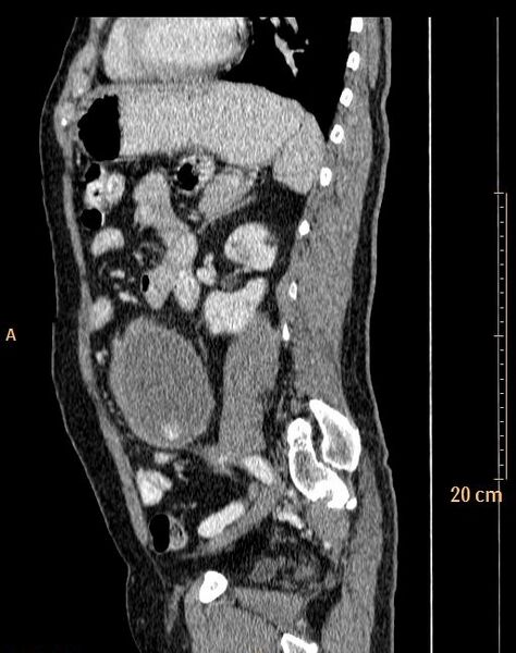 File:Abdominal aortic aneurysm (Radiopaedia 25985-26121 Sagittal C+ arterial phase 1).jpg