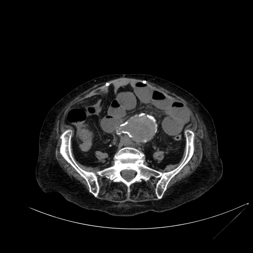 Abdominal aortic aneurysm - impending rupture (Radiopaedia 19233-19246 Axial non-contrast 86).jpg