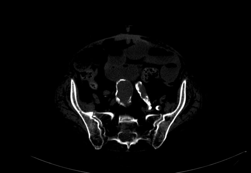 File:Abdominal aortic aneurysm - impending rupture (Radiopaedia 19233-19246 B 44).jpg