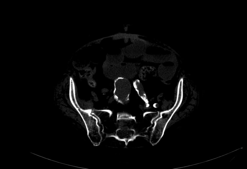 Abdominal aortic aneurysm - impending rupture (Radiopaedia 19233-19246 B 44).jpg